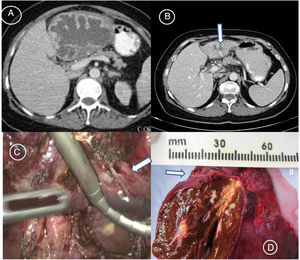 Patient no. 1. (A) Admission CT Scan showing a huge left hepatic lobe abscess of unknown origin. (B) Postdrainage control CT Scan showing an atrophic left hepatic lobe with the residual hepatic abscess and a high-density linear lesion inside (arrow). (C) Laparoscopic view of the fish bone (arrow). (D) Corresponding gross specimen of the resected left lateral segment of the liver. The fish bone (arrow) is shown horizontally having migrated into the liver, and the hepatic abscess can be observed. Color version.