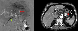 Arteriography and CT angiography showing the pseudoaneurysm (upper arrow on the angiography; solitary arrow on the CT angiography) and the pancreatic duct with contrast (lower arrow).