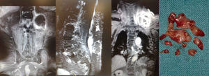 MRI image of the upward progression of the abscess collection in front of the left psoas muscle (station 1) at the superior paraspinal (station 2) and ipsilateral supraclavicular pretrapecial (station 3) areas, with appearance of the samples withdrawn.