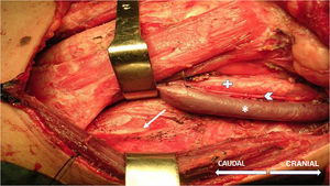 Left phrenic nerve (arrow) after neurophysiological identification with a monopolar probe during lateral cervical lymph node dissection and its relationship with other structures. Asterisk: internal jugular vein; cross: common carotid artery; arrowhead: vagus nerve.