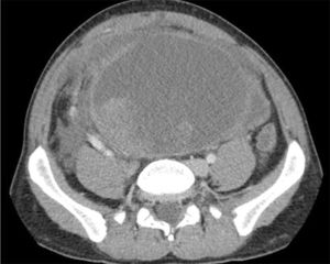 Large solid-cystic mass with secondary right grade II hydronephrosis, free fluid and probable tumor bleeding.