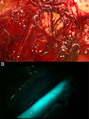 (A) Unfiltered image demonstrating an inflammatory conglomerate in the theoretical location of the left ureter; (B) ICG enhancement in the lumen of the ureter after retrograde injection through the ureteral catheter.