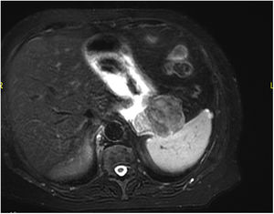 Magnetic resonance imaging showing homogeneous enhancement of the lesion, appearing mainly hypointense both in T1 and T2.