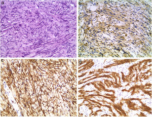 Histological sections showing features typical of both perineurioma and schwannoma (H&E ×100) (a). Immunohistochemical analysis positive for EMA (×100) (b). Immunohistochemical analysis positive for Glut-1 (×200) (c). Immunohistochemical analysis positive for S100 (×200) (d).