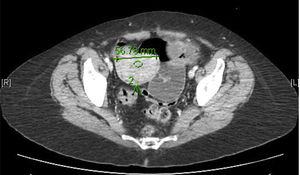 Intestinal mass and secondary intussusception.