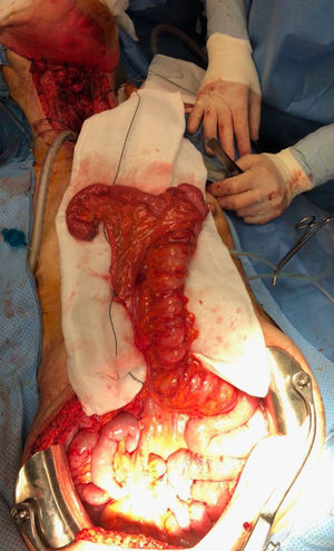 Coloplasty of the right colon after division of the ileocolic vessels.