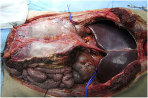 Example of vascularized fascia extraction at our hospital; in the end, its use was not necessary.