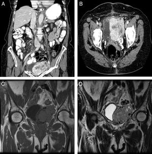 (A and B) A computed tomographic scan shows a 7.5cm×5.4cm×4.2cm pelvic mass with intimate contact to the bladder. The mass was well-defined, solid, and with internal necrotic areas and small peripheral cystic compounds. Multiple and dilated vascular structures located inside were identified. (C and D) A contrast magnetic resonance imaging scan reveals a heterogeneous and hypervascularized solid mass. It shows isointensity in T1-weighted image (C), and partial hyperintensity in T2 (D), with intense contrast uptake.