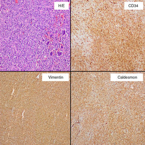 Histological exam shows that the specimen exhibited a high cell-density with an arrangement of short bundles and a mixture of necrotic area and dilated vascular structures (H/E). Immunohistochemical stains show positivity for CD34, vimentin, and caldesmon.