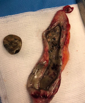 Acute gangrenous appendicitis with the lumen obstructed by a compaction of shotgun pellets measuring 1.7cm, with distal loose pellets.