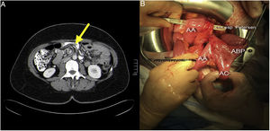 (A) Whirl sign on CT; (B) mesenteric defects.