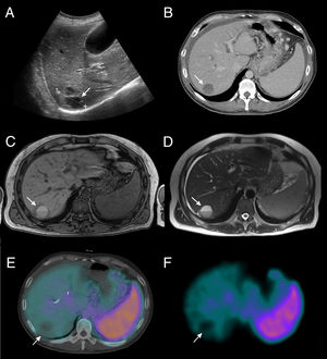 (A) Abdominal ultrasound showing a well-defined, solid nodular image measuring 4.5cm in diameter in the liver parenchyma (arrow); (B) abdominal CT scan showing hypodense hepatic lesion (arrow) with hypervascular behavior and little enhancement, solid-cystic characteristics at the lower end, and levels inside, suggesting that it is a hypervascular SOL with rapid growth and necrosis, compatible with a hydatid cyst, abscess, hemangioma or metastasis; (C and D) MRI in sequences T1 and T2, respectively, which highlight a nodular lesion (arrow) with cystic-necrotic areas and irregular contrast uptake that presents portal lavage; also the size has increased compared to previous tests; (E and F) SPECT/CT and SPECT, respectively, with 99mTc-marked red blood cells of the abdomen showing an absence of tracer uptake compared to the hepatic lesion being studied (arrow).