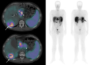 SPECT/CT (left) and complete body (right) of 99mTc-octreotide showing an epigastric mass with increased heterogeneous uptake of somatostatin analogs, correlating with the mass in the body and tail of the pancreas that had been observed in previous tests (arrowhead). Regarding hepatic nodular lesion, hyperuptake was seen in the peripheral halo (arrow), with absence of uptake enhancement, probably related to areas of central necrosis, being therefore compatible with metastasis of a primary pancreatic neuroendocrine tumor.