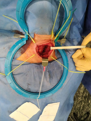 Exposure of the thyroid with the Lone Star® retractor during total thyroidectomy.