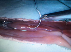 Start of supporting sutures for the manual side-to-side entero-enteric anastomosis with ex vivo porcine viscera in a laparoscopic endotrainer.