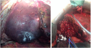 Intraoperative image of the last surgical intervention where an extensive liver necrosectomy was done to complete the right hepatectomy.