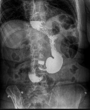 Upper gastrointestinal series: paraesophageal hernia and altered gastric morphology secondary to POSE.