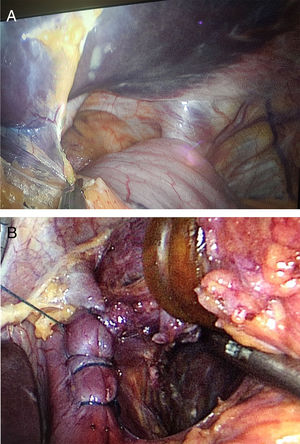 (A) Intraoperative finding of a giant hiatal hernia; (B) the hernia defect was closed with continuous barbed suture.