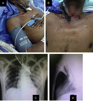 (A) Sharp object embedded at the stabbing site, immediately left of the manubrium sterni (lateral view); (B) anterior view; (C) posteroanterior chest radiograph showing left hydropneumothorax and the sharp object embedded in the left hemithorax; (D) lateral radiograph of the thorax, where the object seems not to have reached any vital structures.