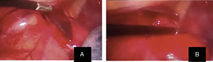 Video-assisted thoracoscopy images: (A) 15-cm sharp object lodged in the left thorax, penetrating through the sternal notch immediately medial to the subclavian artery; (B) blood clot of 500cm3.
