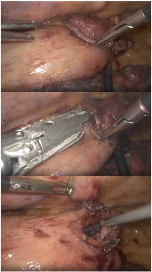 Mechanical side-to-side anastomosis in prone in the Ivor-Lewis. 1-1: preparation; 1-2: placement of the linear endostapler prior to stapling; 1-3: preparation for manual closure.
