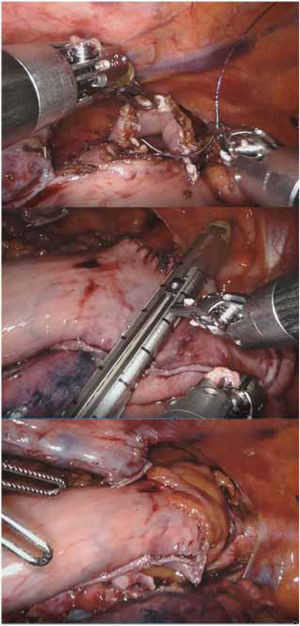 End-to-side robotic manual anastomosis in prone in Ivor-Lewis.2-1: start of the barbed suture on the anterior side; 2-2: division of the redundant gastroplasty; 2-3: omentoplasty.