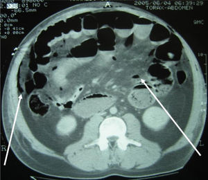 Subcutaneous emphysema in the abdominal wall; pneumoperitoneum; atypical air bubbles are observed in the intra-abdominal fat and greater omentum (abdominal CT scan).