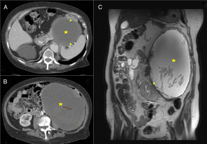 (A and B) CT: cystic mass (marked with a star) compressing and displacing the spleen, colon and left kidney (arrows). (C) MRI-T2: mass with liquid content and heterogeneous internal material (marked with a star); the walls present an irregular morphology and increased thickness, displacing the left kidney downwards and internally (arrow).