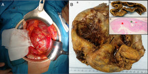 (A) Intraoperative: large retroperitoneal cystic mass displacing the colon and spleen laterally and the left kidney downwards prior to resection; (B) Anatomic pathology: (a) surgical piece measuring 18.5×15.5×4cm, yellowish in color, (b) corresponding with a cystic cavity with a friable, rough wall that is brownish in color, ranging between 4 and 10mm in thickness. (c) Histologically, the mass corresponded with an adrenal adenoma with cystic degeneration secondary to hemorrhage, with fibrinoid necrosis (red star) (green star shows the remains of the adrenal cortex). The colors of the figure can only be seen in the electronic version of the article.