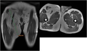 MRI showing a giant right soft tissue tumor, poorly defined and with fat intensity.