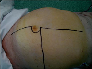 Extensive laparotomy incision with lateral extension.