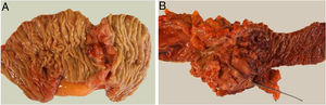 Pathological study of the surgical resection specimens after duodenectomy (A) and pancreaticoduodenectomy (B).