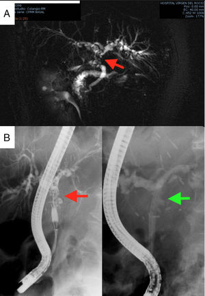 Complementary studies: MRCP diagnosing anastomotic stenosis, indicated by the red arrow (2A); and therapeutic endoscopic retrograde cholangiopancreatography for the placement of plastic biliary stents. The arrow in the left image indicates the stenosis, while in the image on the right the stenosis is resolved with the plastic prosthesis (2B).