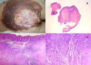 (A) Image of the perineal, bilateral buttock and sacral lesion with suppurative areas and areas of suspected tumor invasion; (B) Well-differentiated endophytic squamous lesion (H&E ×4); (C) Nests of squamous cells with densely eosinophilic cytoplasm (H&E ×40); (D) Epithelial-stromal interface (H&E ×200).