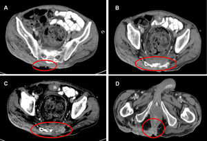 Selection of pelvic CT images: (A) Extensive subcutaneous tissue involvement ranging from L4; (B and C) Invasion of the sacral bone with bone destruction in certain areas; (D) Involvement of the right posterior external sphincter.