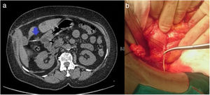 (a) Axial slice of the CT scan, showing a foreign body (fishbone, blue arrow); on the right; (b) intraoperative image where the bone is observed in the fistula tract to the liver. The figure colors can only be seen in the electronic version of the article.