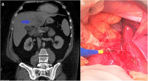 (a) Axial slice of the CT scan, showing intrahepatic abscess in the left hepatic lobe indicated by the blue arrow; (b) intraoperative image during the extraction of the fishbone from the liver. The figure colors can only be seen in the electronic version of the article.
