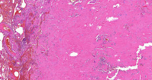 Amyloidoma in the LUL (×5, hematoxylin–eosin stain).