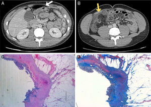 (A) Axial view on CT showing hydropneumoperitoneum (white arrow); (B) axial view on CT showing intestinal wall thickening in the ileocecal region with evidence of extraluminal bubbles (yellow arrow); (C) histopathological study (panoramic) demonstrating an area of ulceration and chronic inflammatory infiltrate, accompanied by fibrous tracts that distort and fade the muscle layer; (D) histopathological study (Masson's trichrome stain) showing wall thickening due to fibrosis with transmural involvement.