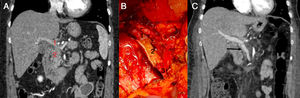 Images of Case 1: A) Abdominal CT before surgery; mesenteric-portal confluence (1) and pancreatic tumor (2); B) portal vein (1), tubular graft of rectus abdominis (2), superior mesenteric vein (3); C) abdominal CT after surgery showing correct operation of the graft.