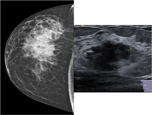Mammogram showing a mass in the upper outer quadrant of the right breast. On the right, ultrasound showing the lesion classified as BIRADS IVb.