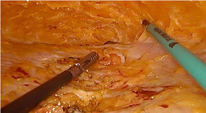 Complete subcutaneous dissection of the linea alba.