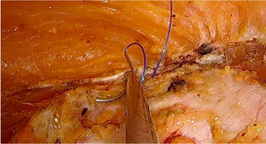 Suture of the medial margins of the anterior muscle sheaths.