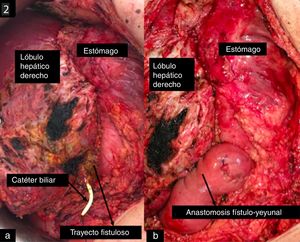 a. Identification of the fistulous tract with the biliary catheter inside between the right hepatic lobe and the stomach. b. Anastomosis of the fistulous tract to the jejunum.