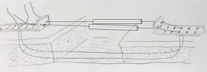 Schematic drawing showing placement of tenstion sutures through opposing plates, skin and subcutaneous tissue (the holes in the plates allow placement of skin staples).