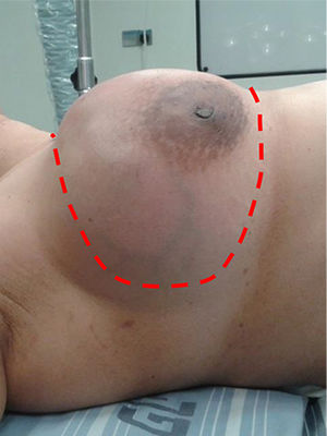 Preoperative view of a breast with a large phyllodes tumor (red dash line indicates skin incision).