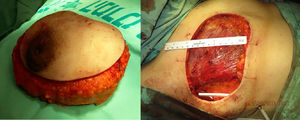 Intraoperative view — notice pressure marks created on the skin by primary intent to advance wound edges towards the midline using two silk sutures.