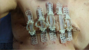 Postoperative view notice the blister between the upper third and fourth plates from the axilla which attests to the line of tension created by the TRS away from the surgical wound margins.