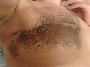 Optimal healing of the surgical wound allows provision of chest wall radiotherapy without delay.