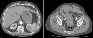 Axial CT scans: right, showing active splenic hemorrhage; left, showing free fluid in the pelvis.